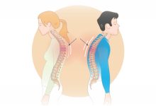 قوز کمر چند سانت قد را کوتاه میکند؟