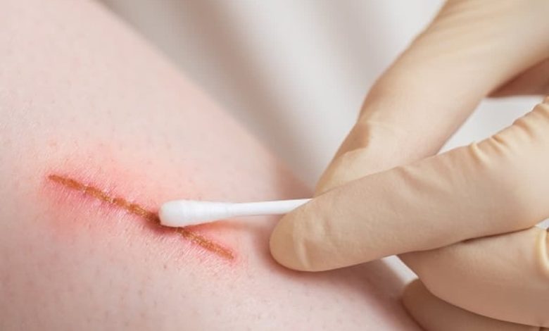 عفونت چگونه از بدن خارج میشود