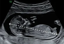 قد جنین در سونوگرافی با چه علامتی مشخص میشود؟